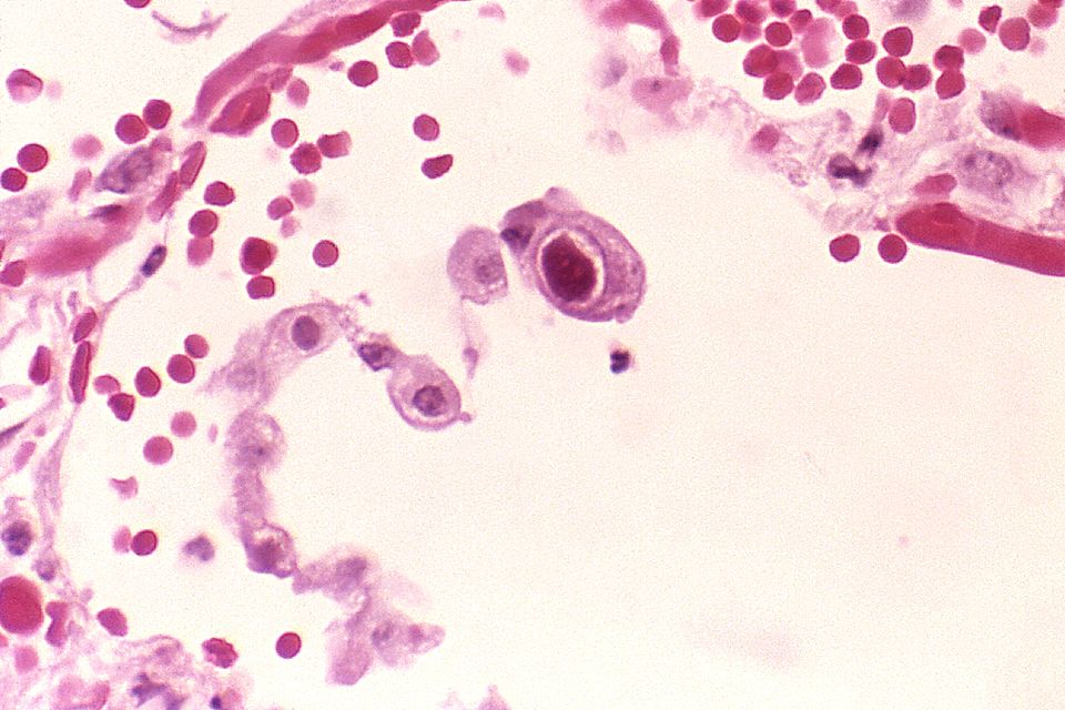 A lung cell infected by Human Cytomegalovirus